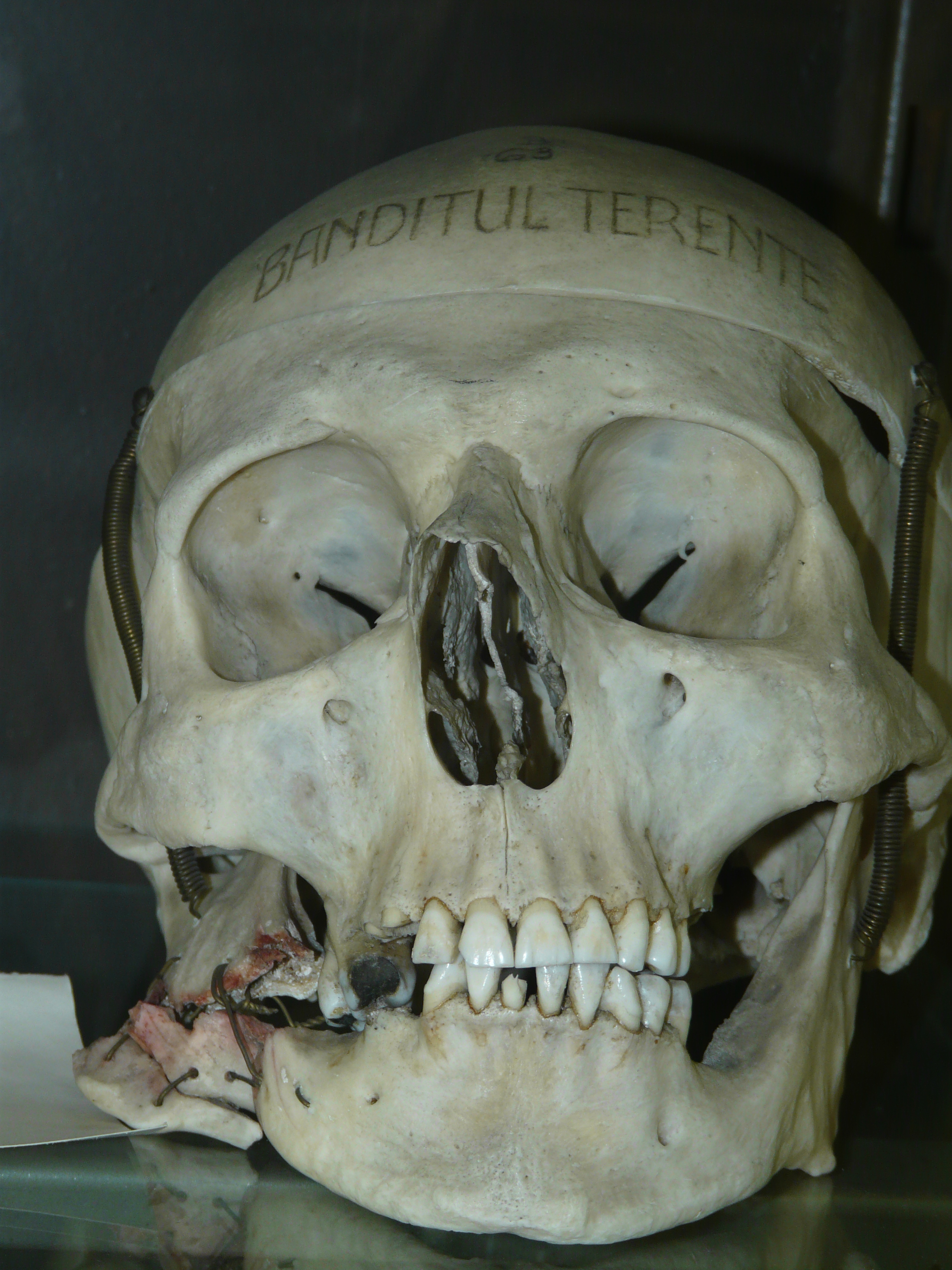 Craniul lui Terente expus la Institutul de Medicină Legală. Se vede (în partea stângă) locul în care a fost împușcat.
